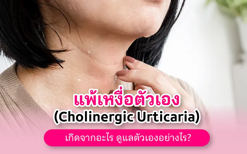 แพ้เหงื่อตัวเอง (cholinergic Urticaria) เกิดจากอะไร ดูแลตัวเองอย่างไร 02